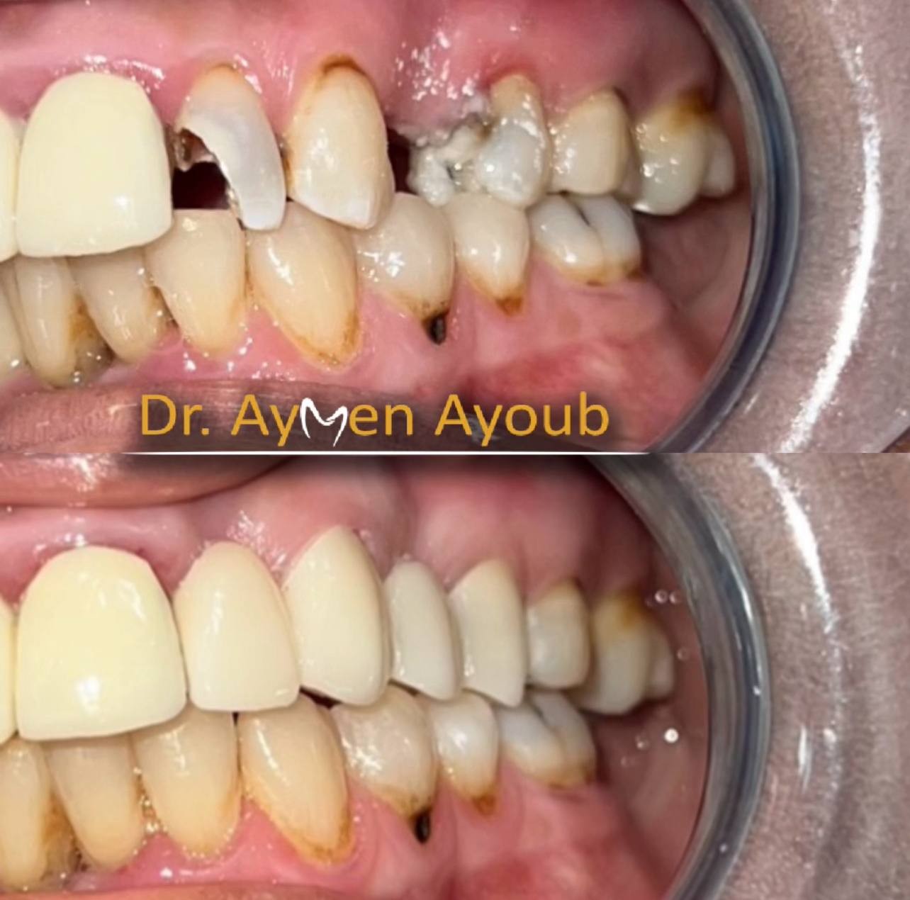 Before-and-after or treatment-stage image 1 for crowns and bridges at Aya Dental Studio