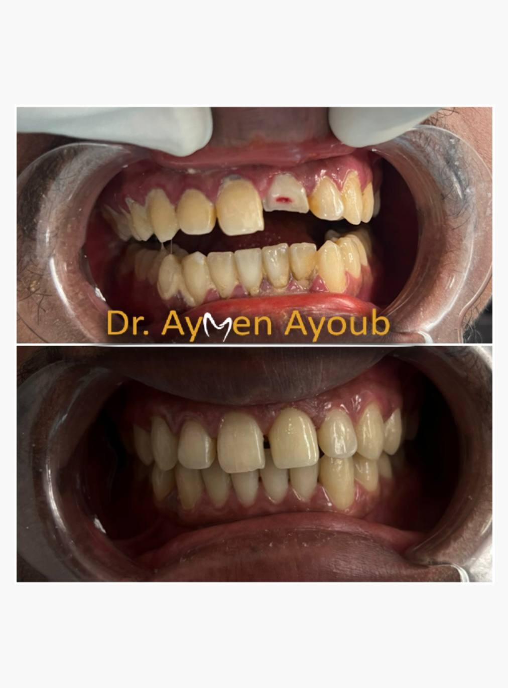 Before-and-after or treatment-stage image 2 for crowns and bridges at Aya Dental Studio