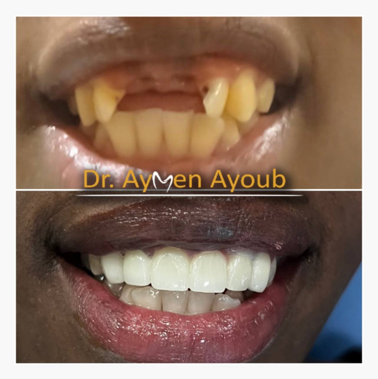 Before-and-after or treatment-stage image 3 for crowns and bridges at Aya Dental Studio