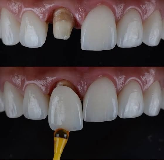 Before-and-after or treatment-stage image 4 for crowns and bridges at Aya Dental Studio