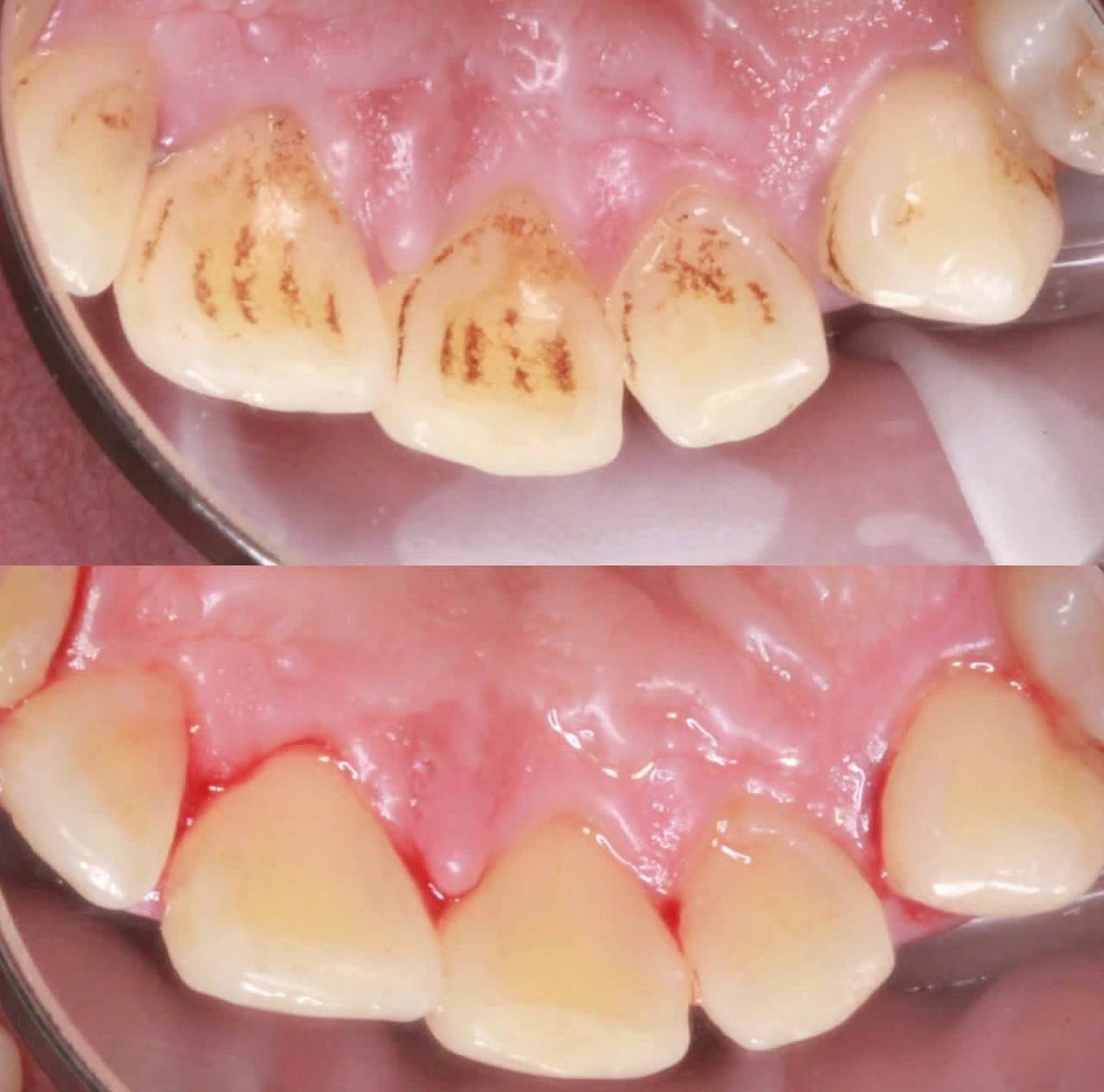 Before-and-after or treatment-stage image 1 for dental cleaning at Aya Dental Studio