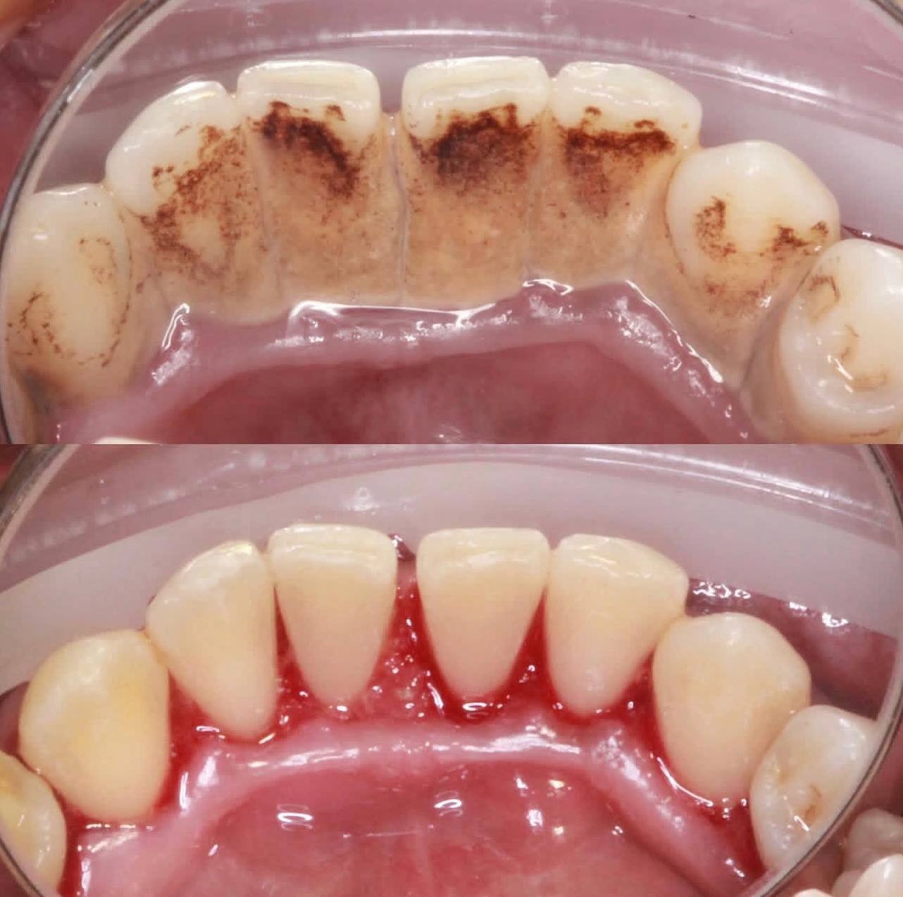 Before-and-after or treatment-stage image 2 for dental cleaning at Aya Dental Studio