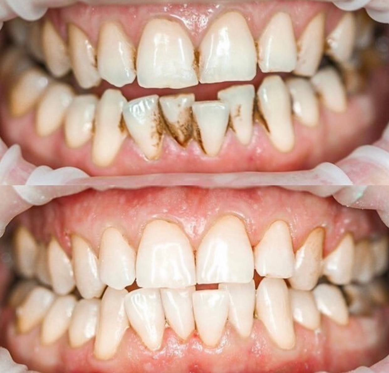 Before-and-after or treatment-stage image 3 for dental cleaning at Aya Dental Studio