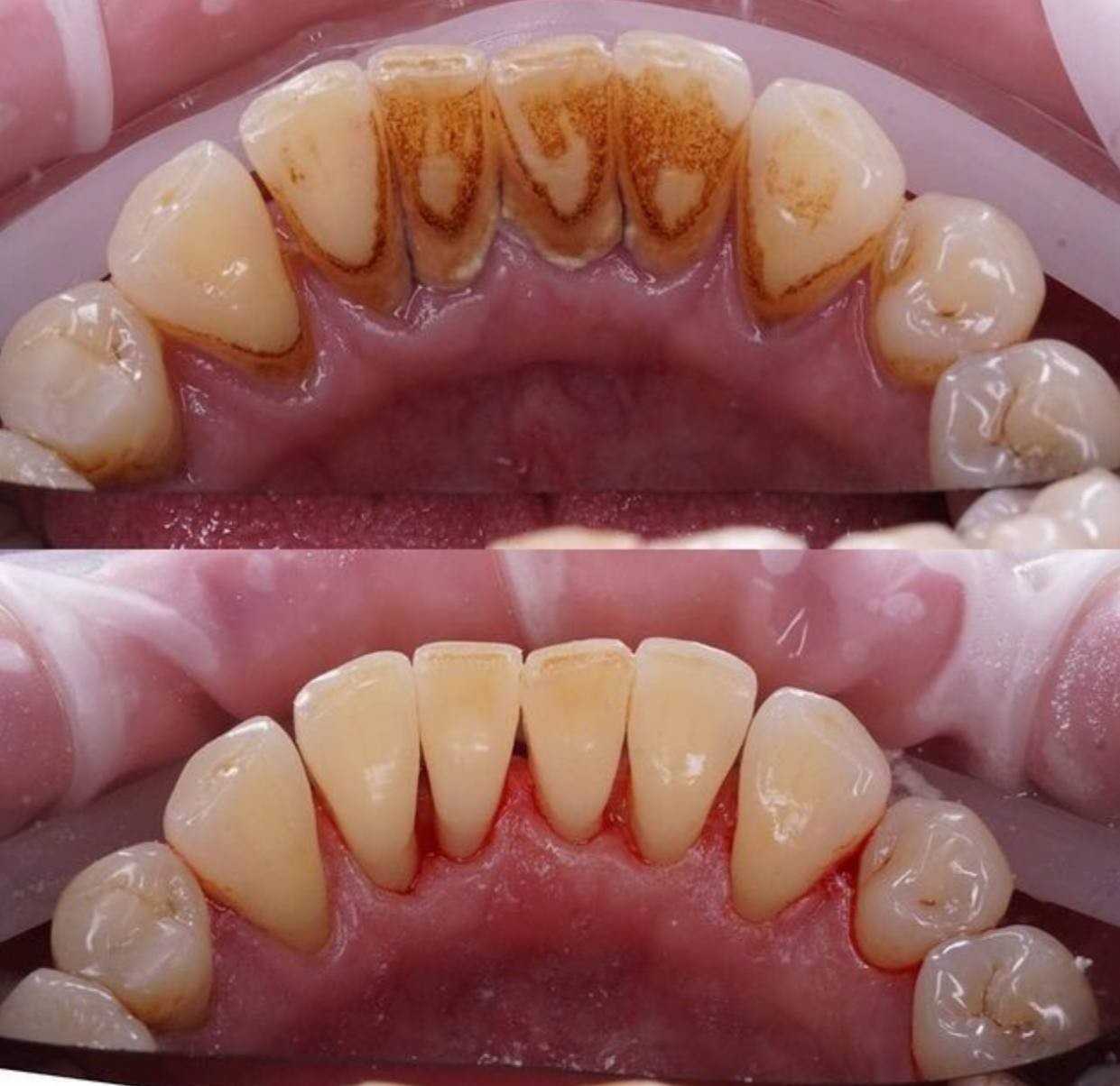 Before-and-after or treatment-stage image 4 for dental cleaning at Aya Dental Studio