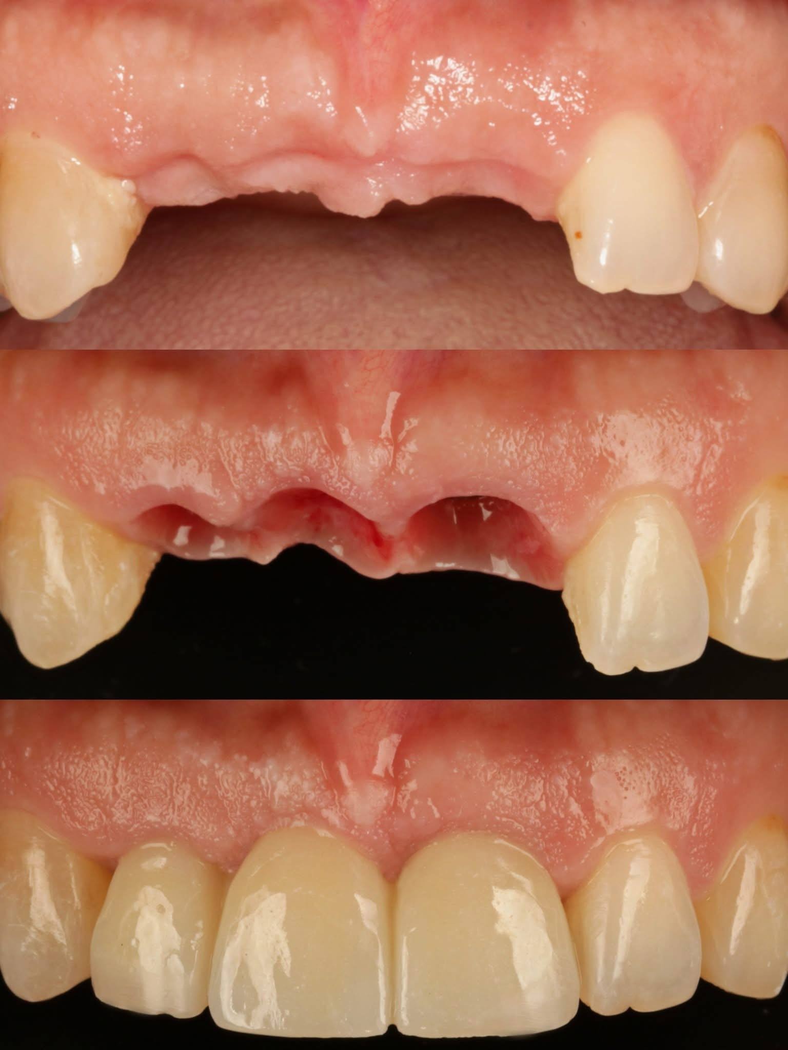 Before-and-after or treatment-stage image 1 for dental implants at Aya Dental Studio