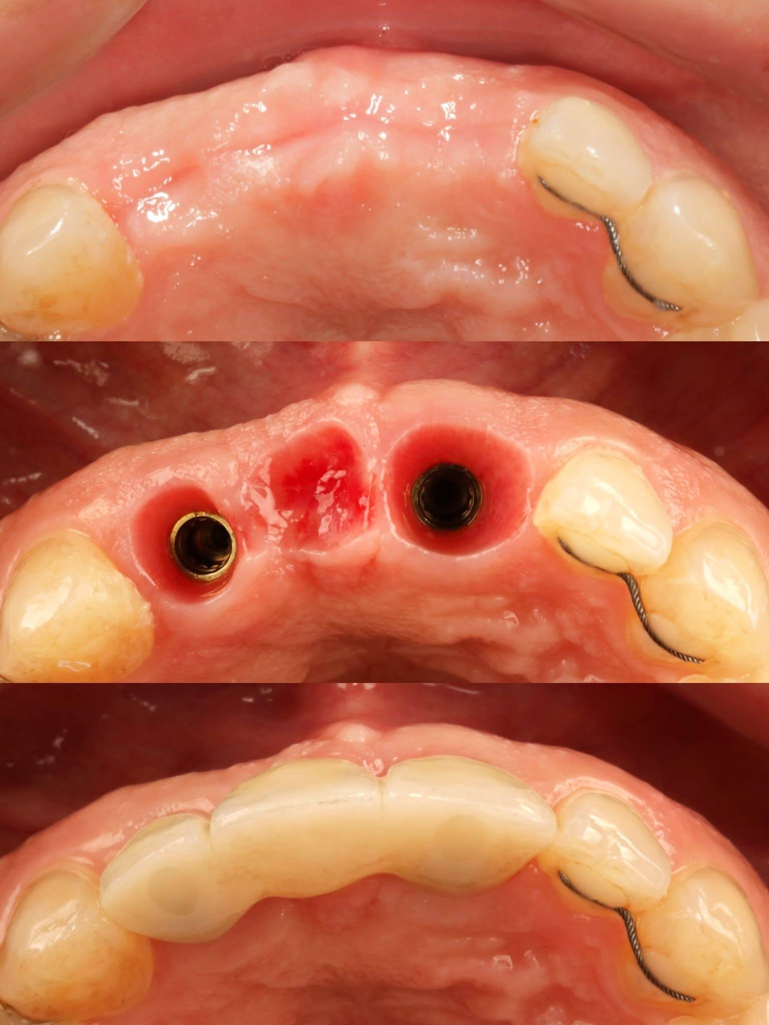 Before-and-after or treatment-stage image 2 for dental implants at Aya Dental Studio