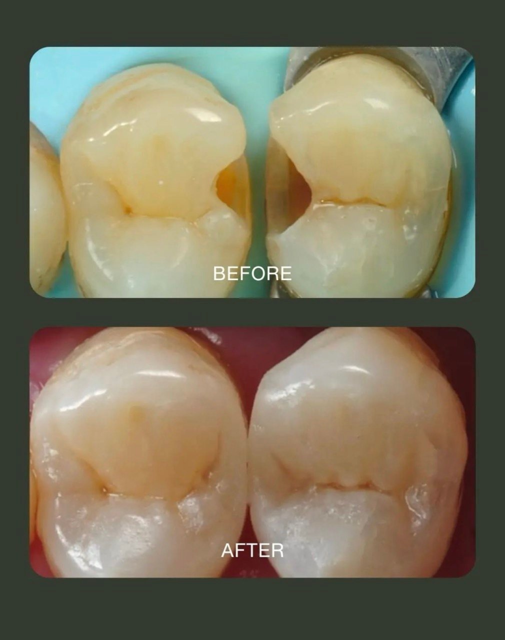 Before-and-after or treatment-stage image 1 for dental fillings at Aya Dental Studio