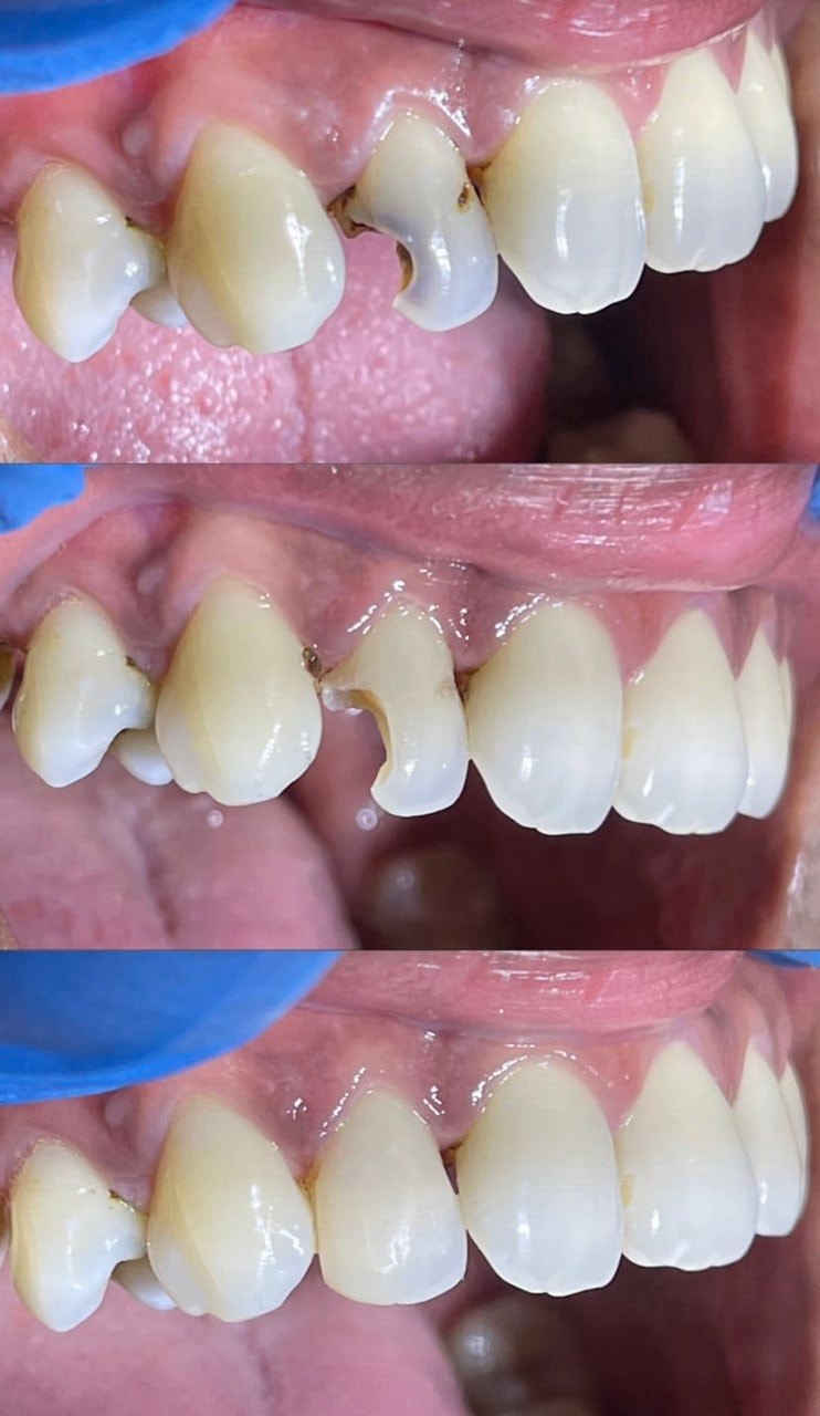 Before-and-after or treatment-stage image 2 for dental fillings at Aya Dental Studio