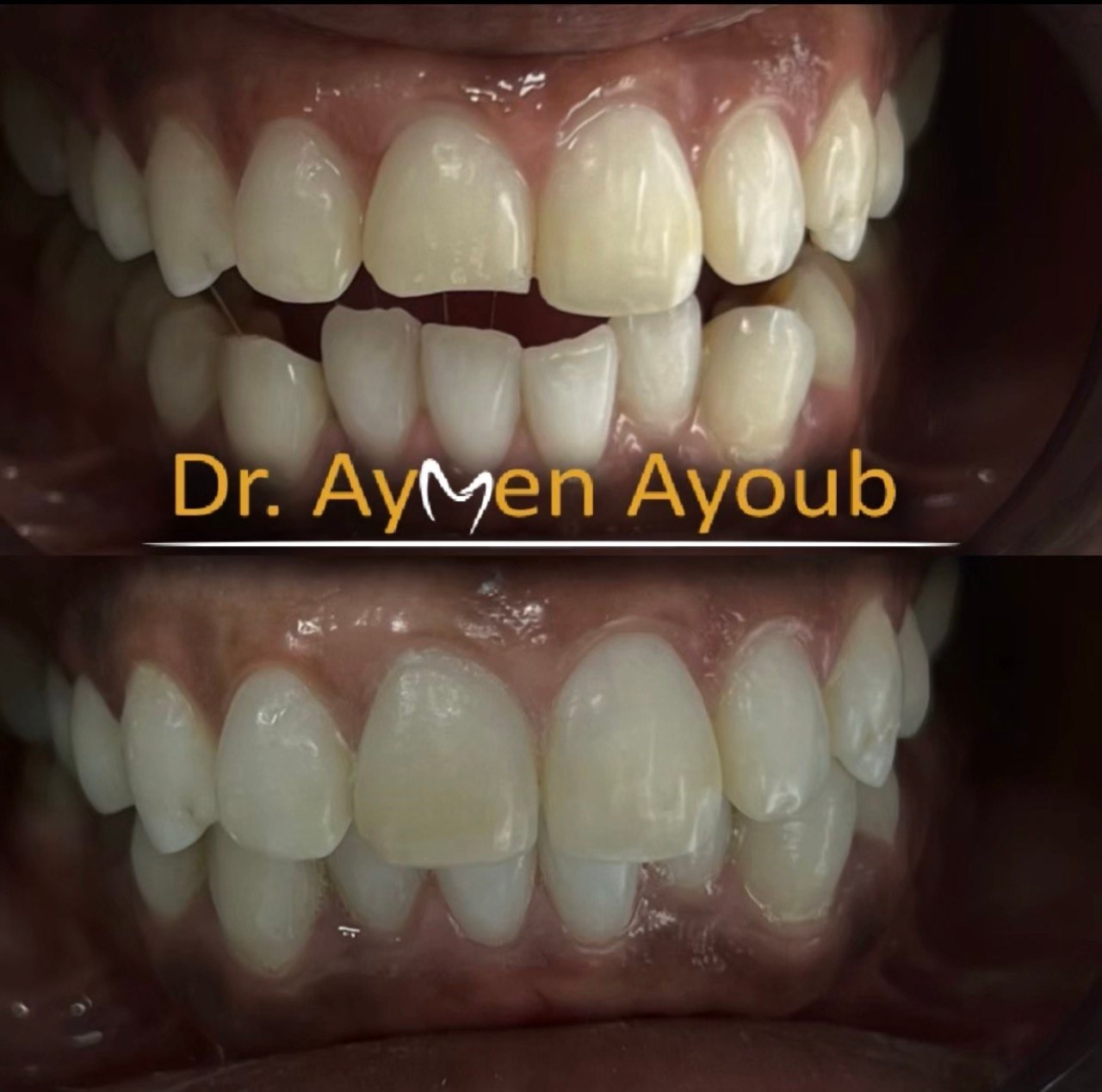 Before-and-after or treatment-stage image 4 for dental fillings at Aya Dental Studio