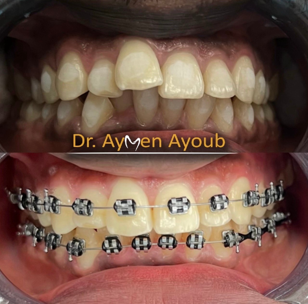 Before-and-after or treatment-stage image 1 for orthodontic treatment at Aya Dental Studio