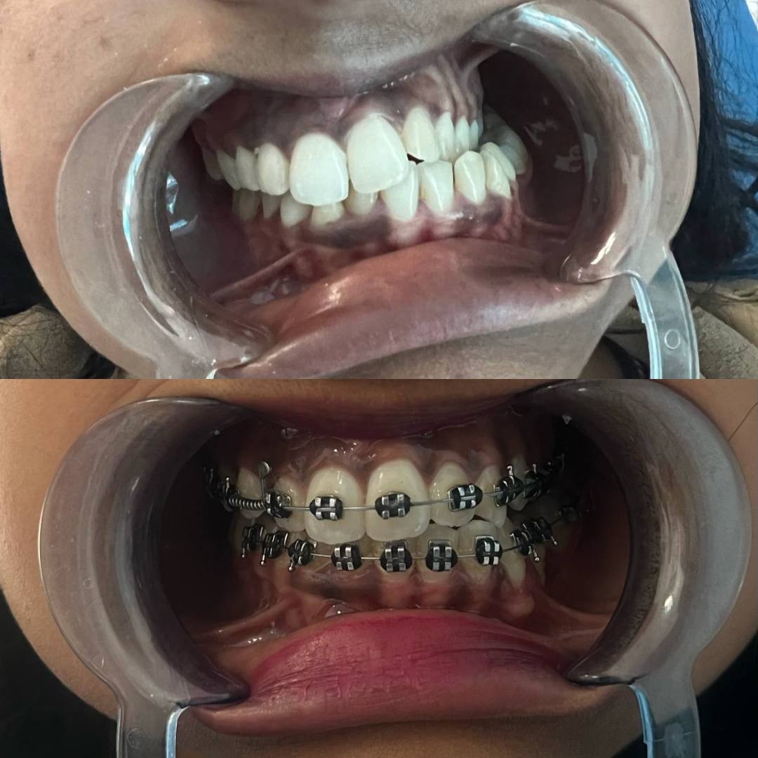 Before-and-after or treatment-stage image 2 for orthodontic treatment at Aya Dental Studio