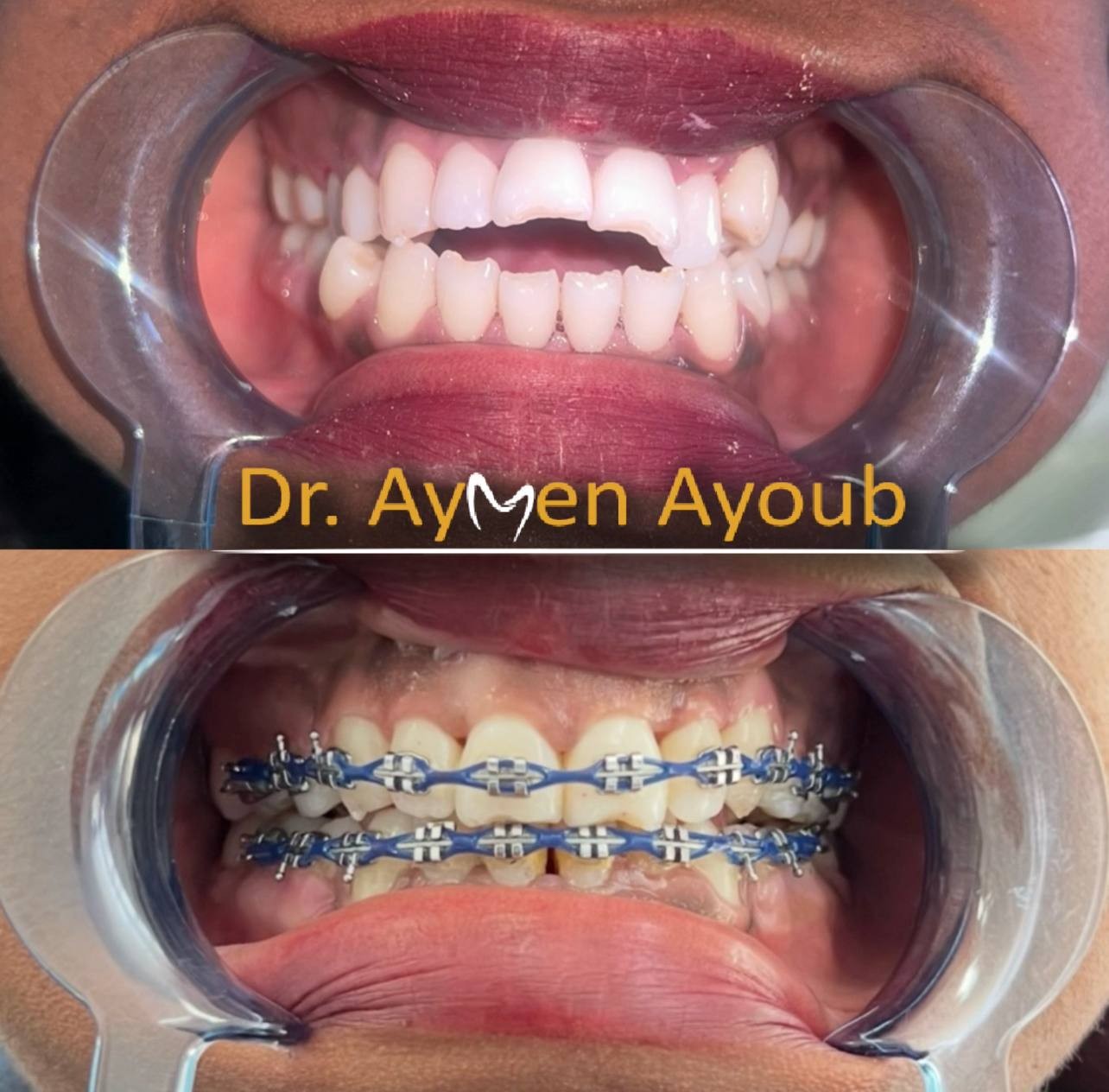 Before-and-after or treatment-stage image 3 for orthodontic treatment at Aya Dental Studio