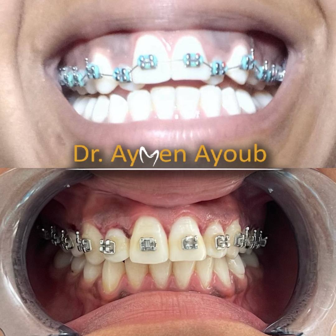 Before-and-after or treatment-stage image 4 for orthodontic treatment at Aya Dental Studio