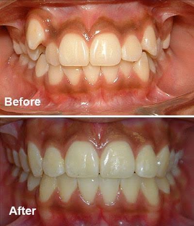Before-and-after or treatment-stage image 5 for orthodontic treatment at Aya Dental Studio
