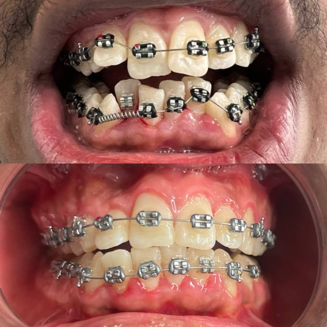 Before-and-after or treatment-stage image 6 for orthodontic treatment at Aya Dental Studio