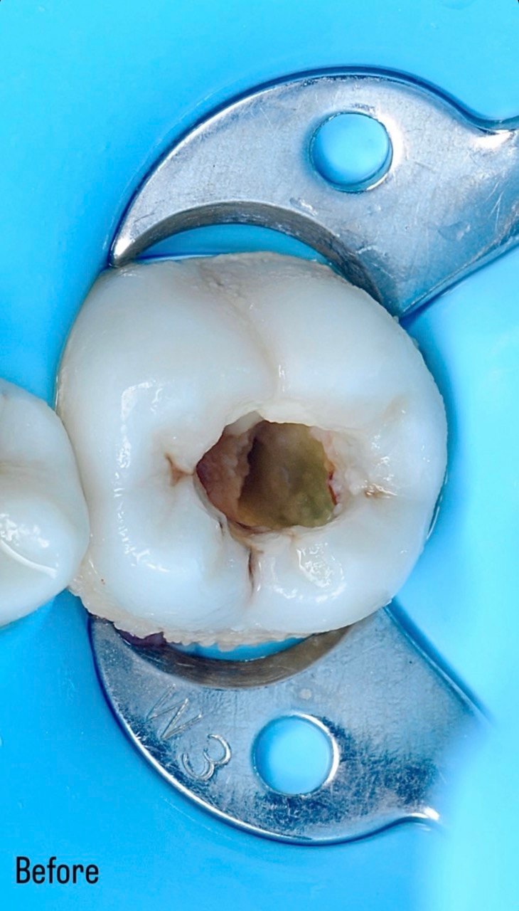 Before-and-after or treatment-stage image 1 for root canal treatment at Aya Dental Studio