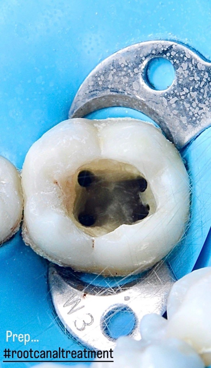 Before-and-after or treatment-stage image 2 for root canal treatment at Aya Dental Studio