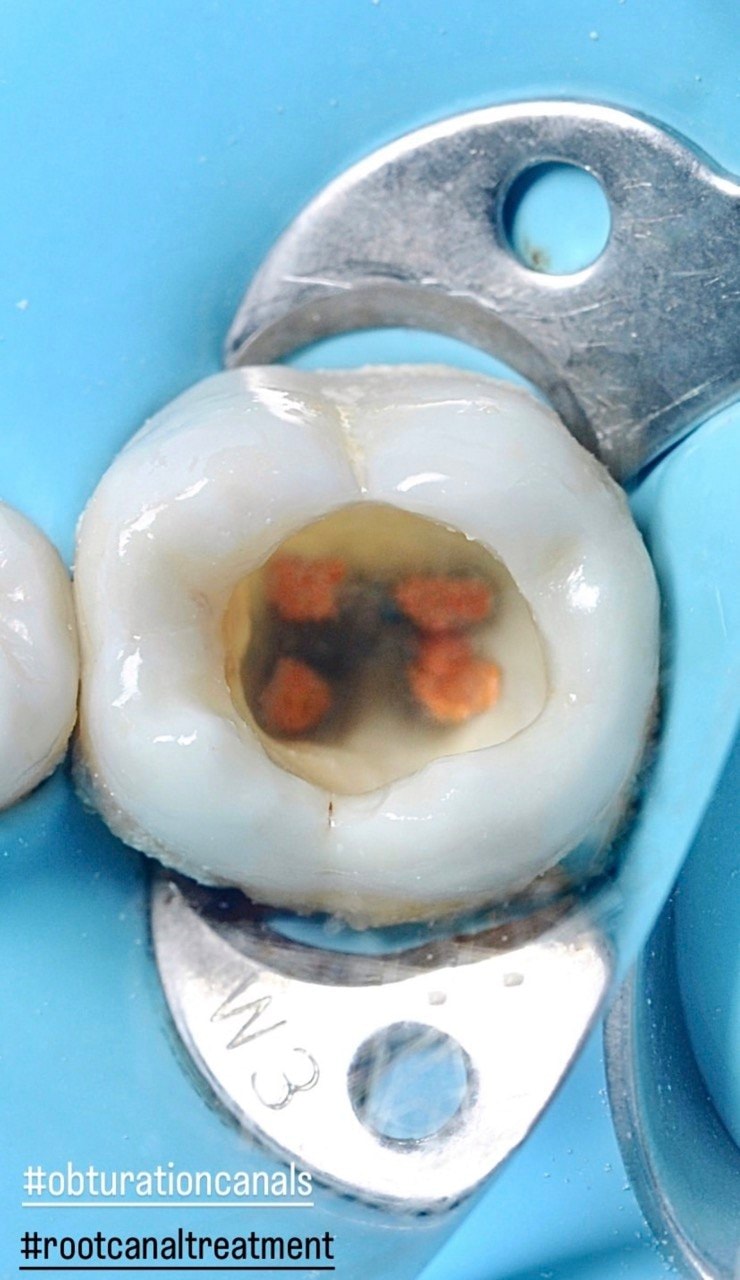 Before-and-after or treatment-stage image 3 for root canal treatment at Aya Dental Studio