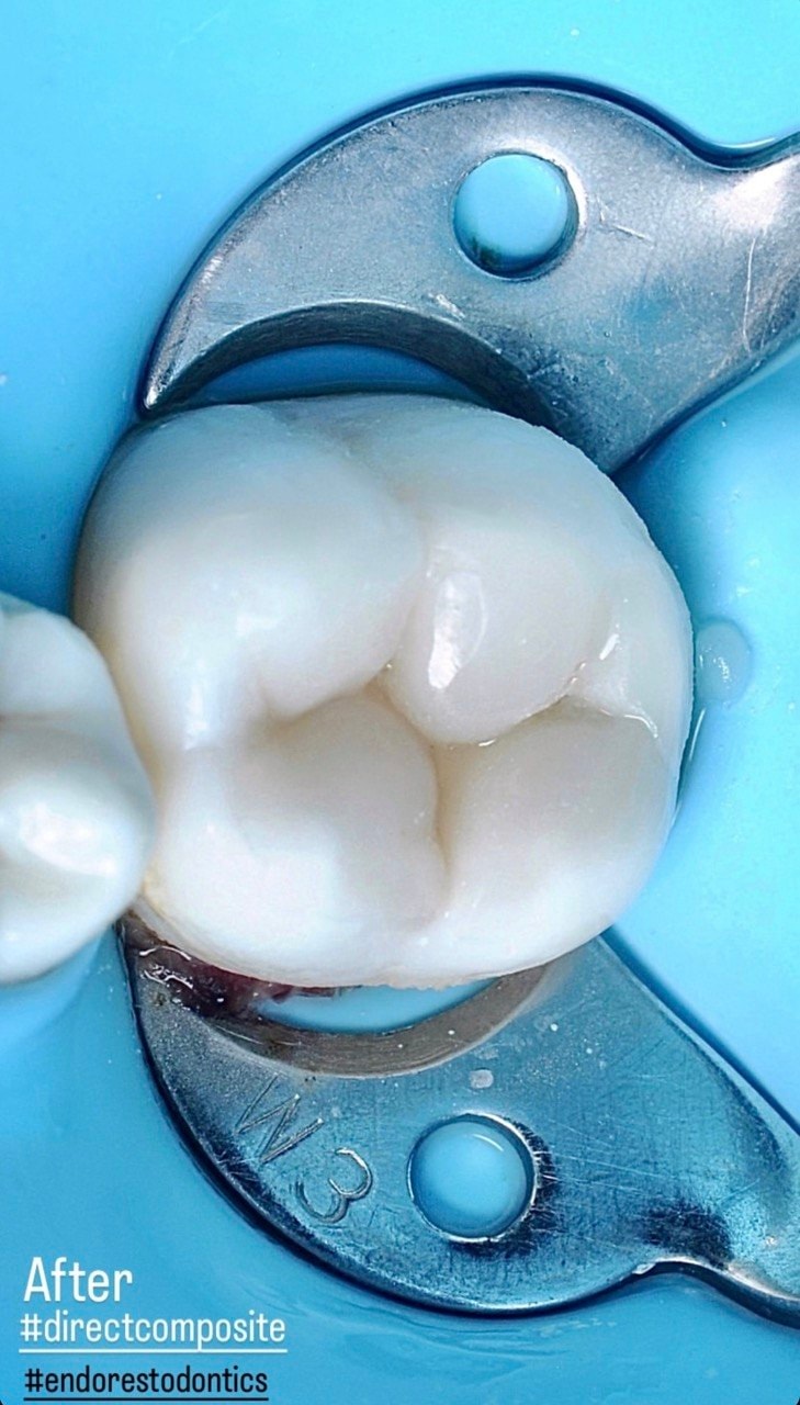 Before-and-after or treatment-stage image 4 for root canal treatment at Aya Dental Studio
