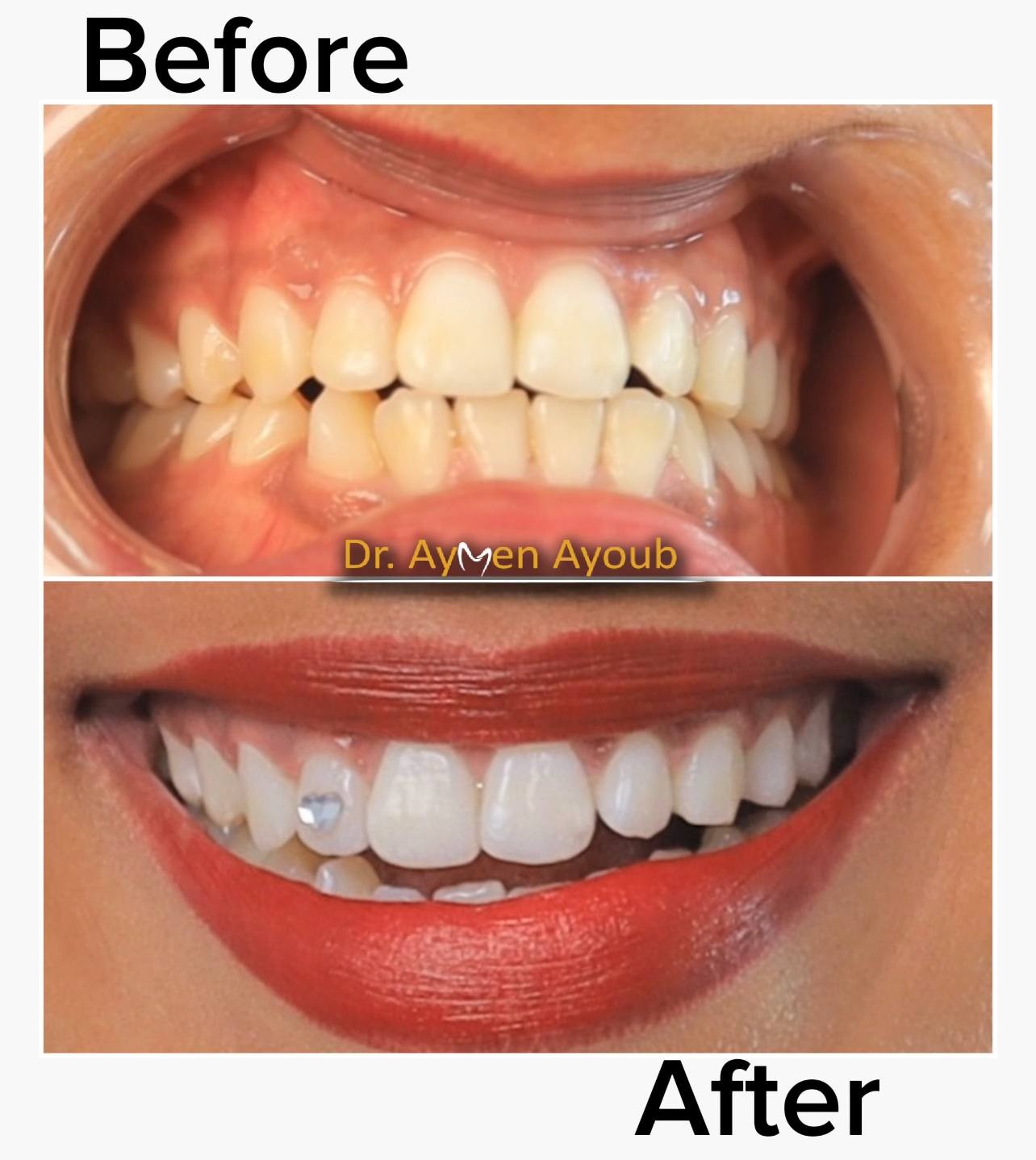 Before-and-after or treatment-stage image 1 for teeth whitening at Aya Dental Studio