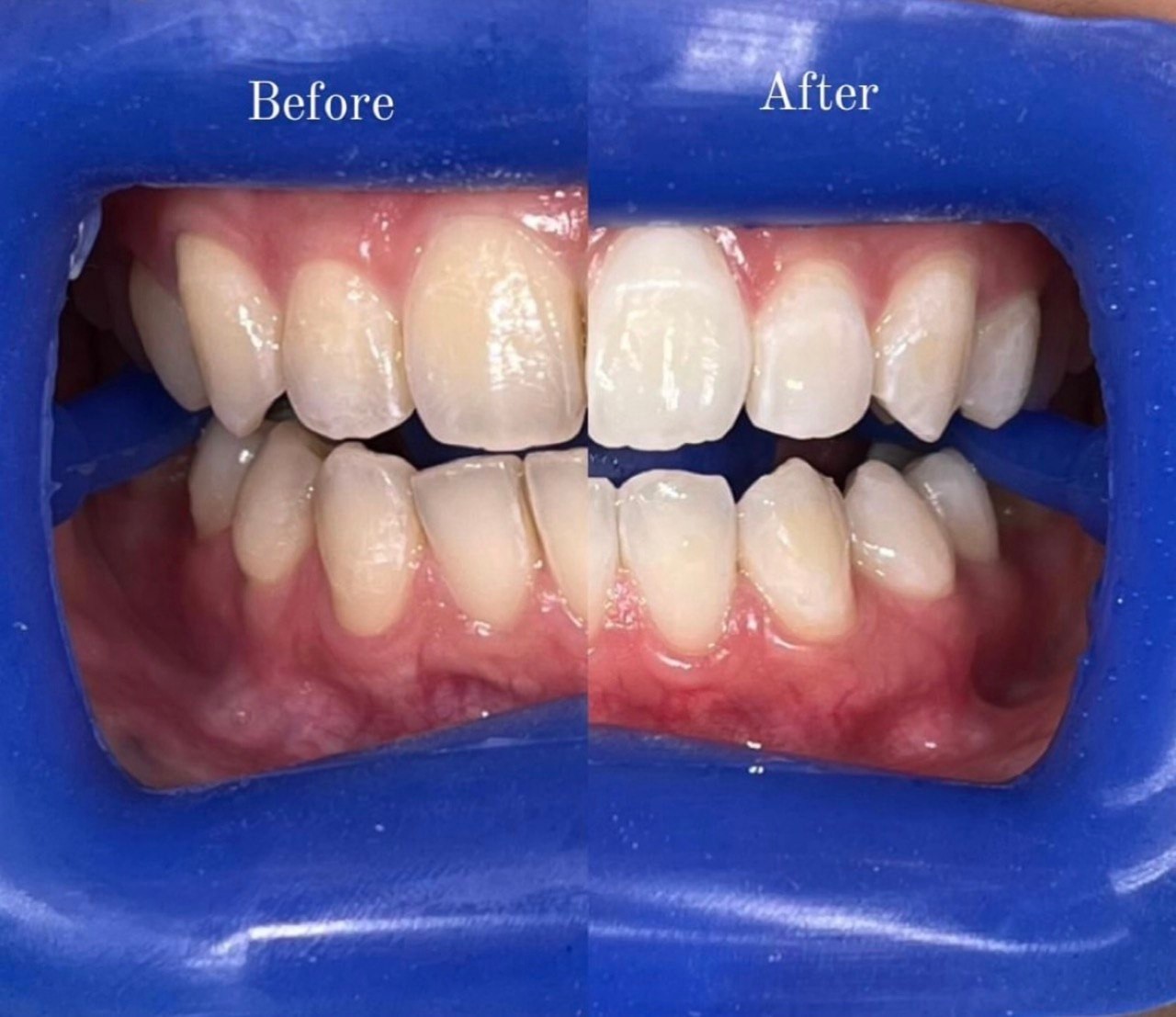 Before-and-after or treatment-stage image 2 for teeth whitening at Aya Dental Studio