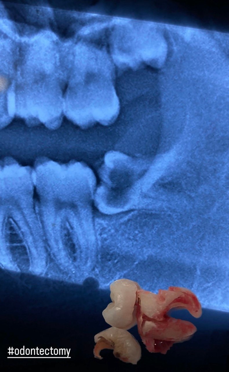 Before-and-after or treatment-stage image 1 for tooth extraction at Aya Dental Studio