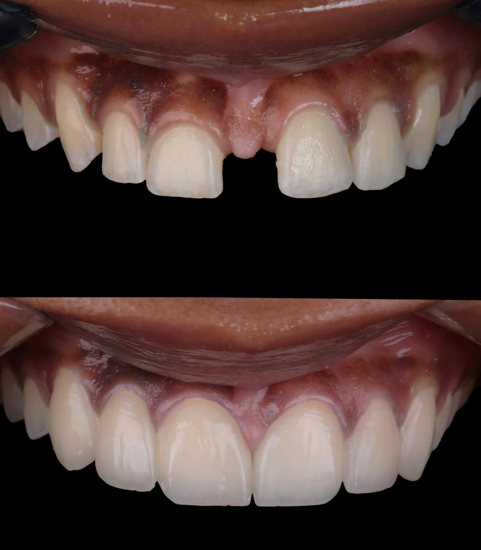 Before-and-after or treatment-stage image 1 for dental veneers at Aya Dental Studio