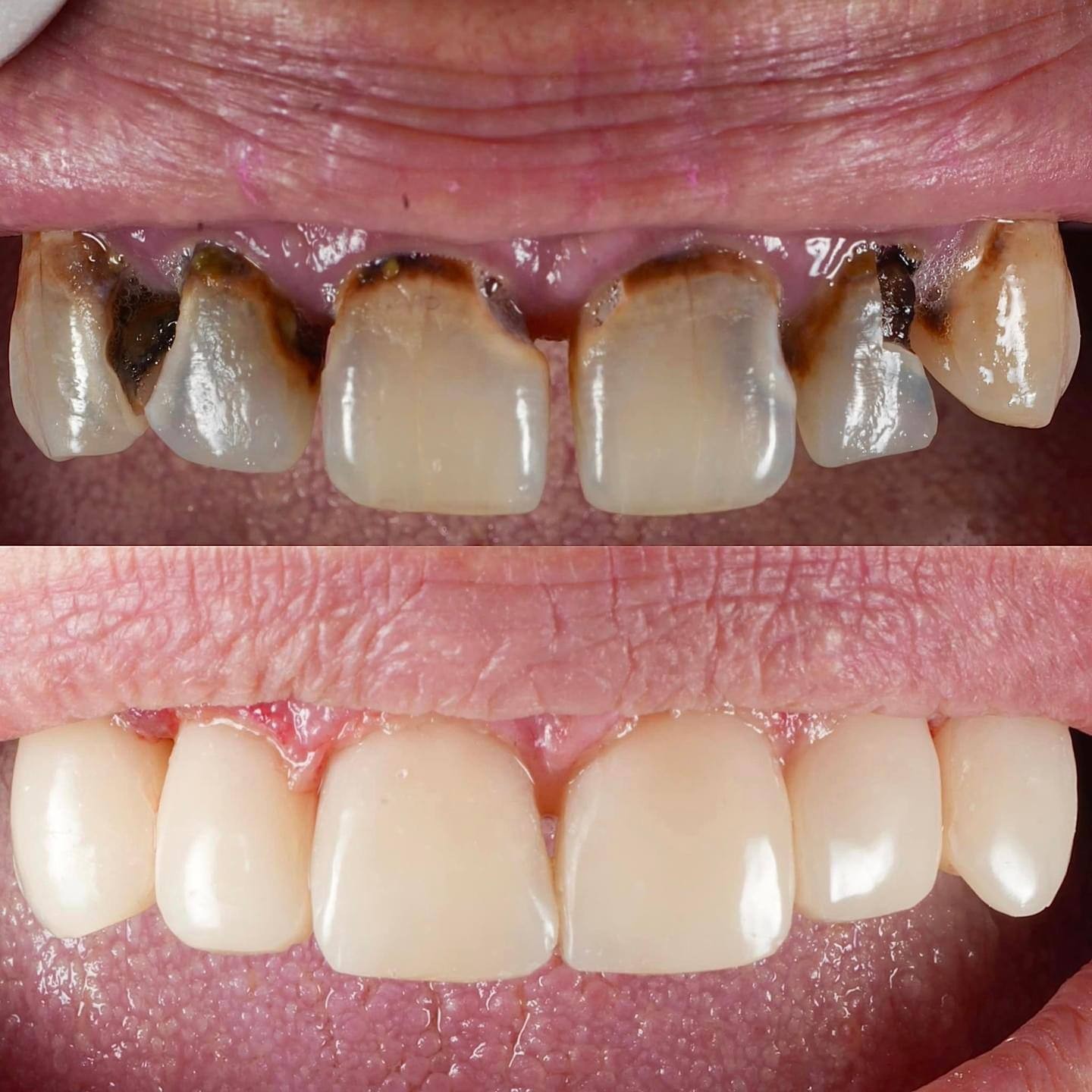 Before-and-after or treatment-stage image 3 for dental veneers at Aya Dental Studio