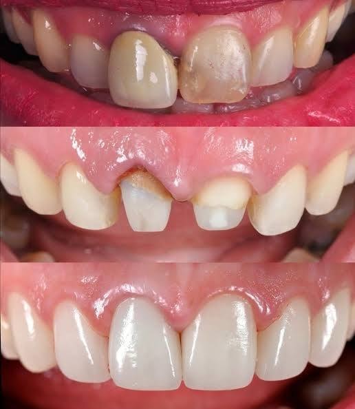 Before-and-after or treatment-stage image 4 for dental veneers at Aya Dental Studio