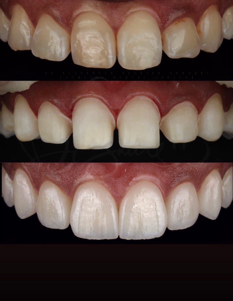 Before-and-after or treatment-stage image 5 for dental veneers at Aya Dental Studio