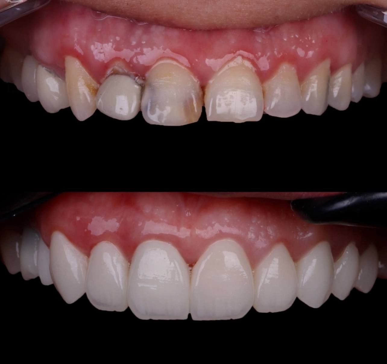 Before and after comparison of cosmetic dental care