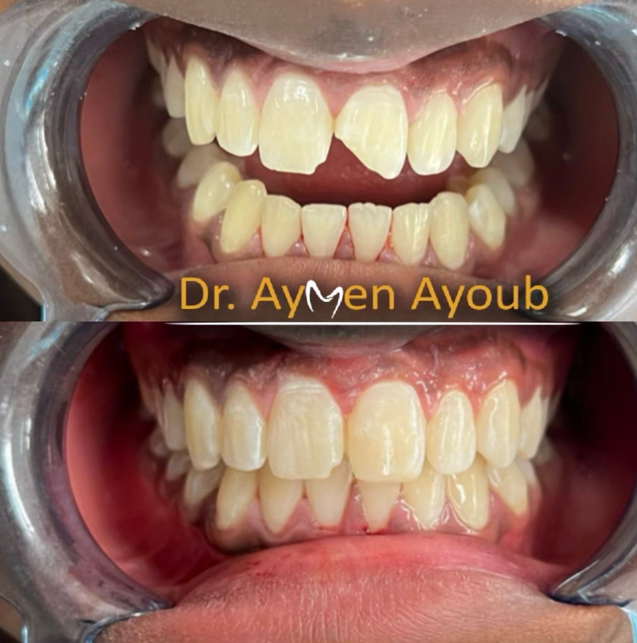Dental restoration preparation illustrated on a tooth model